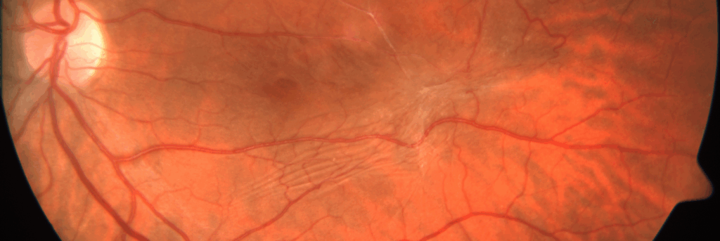 diabetic retinopathy