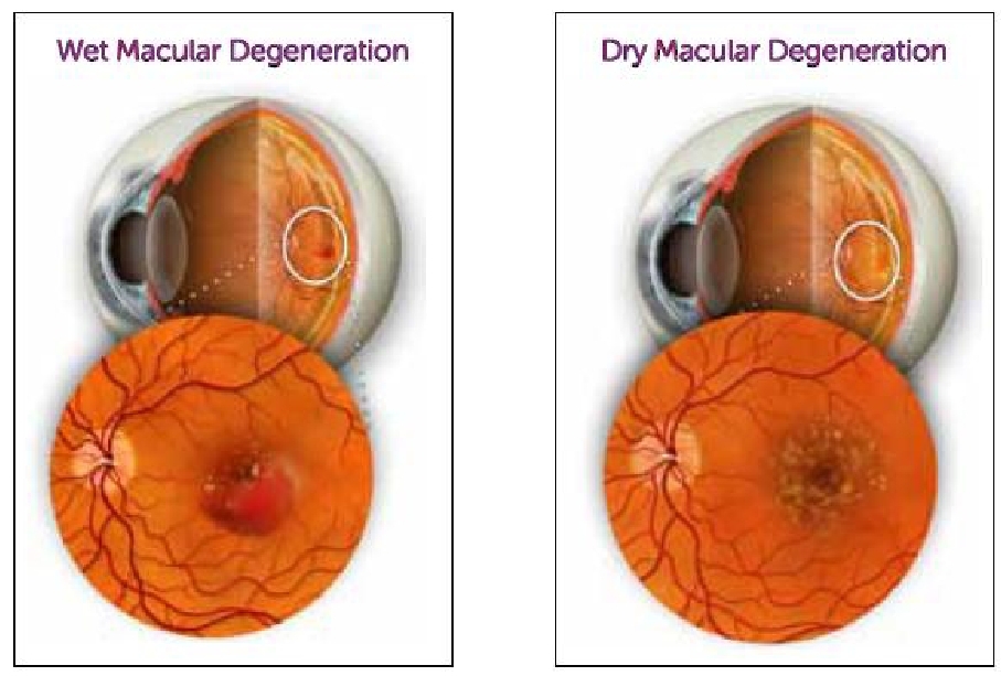 dry macular degeneration oct