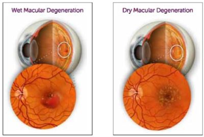 5 Facts About Macular Degeneration - Laguna Hills Eye Doctors