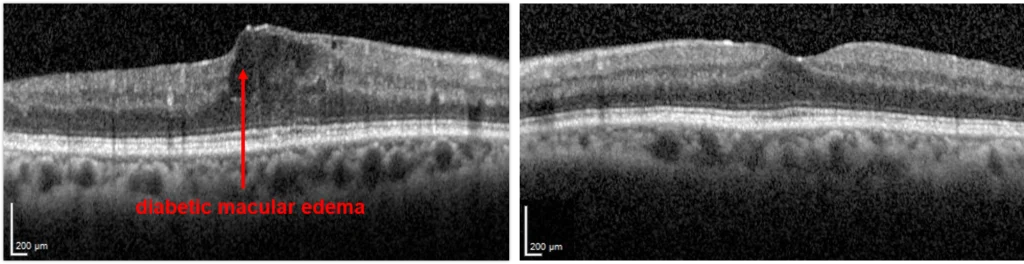 Diabetic Macular Edema