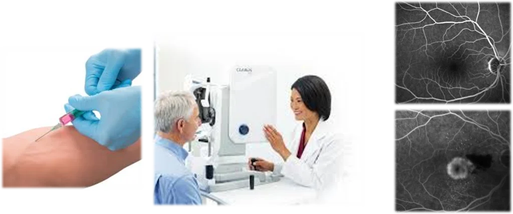 Flourescein Angiography