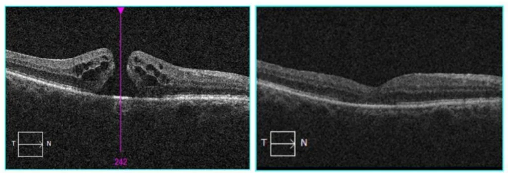 Macular Hole Before and After