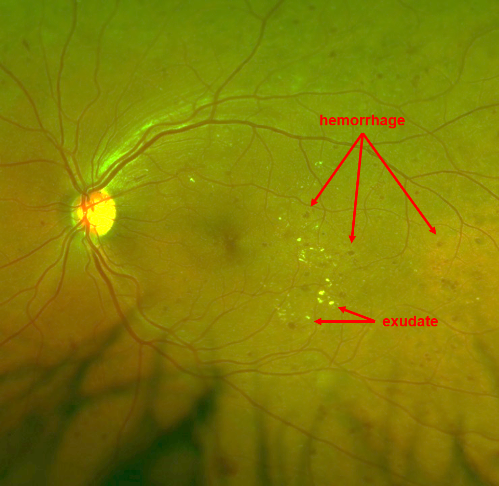 Non-Proliferative Diabetic Retinopathy