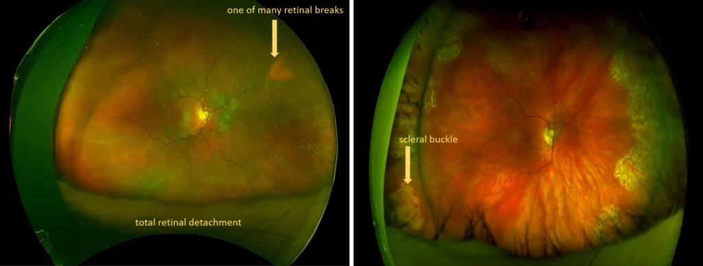 Pars Plana Vitrectomy & Scleral Buckle