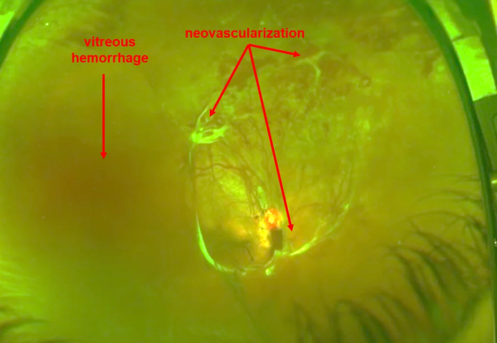 Proliferative Diabetic Retinopathy