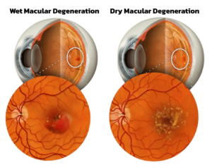 Wet Dry Macular Degeneration