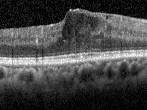 diabetic macular edema