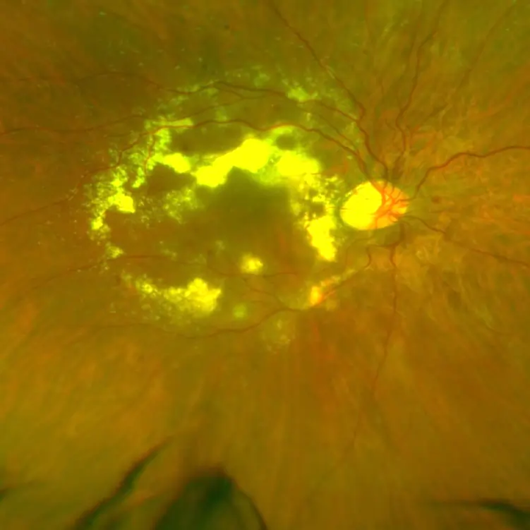 diabetic retinopathy