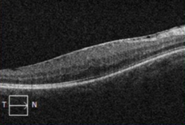 epiretinal membrane macular pucker