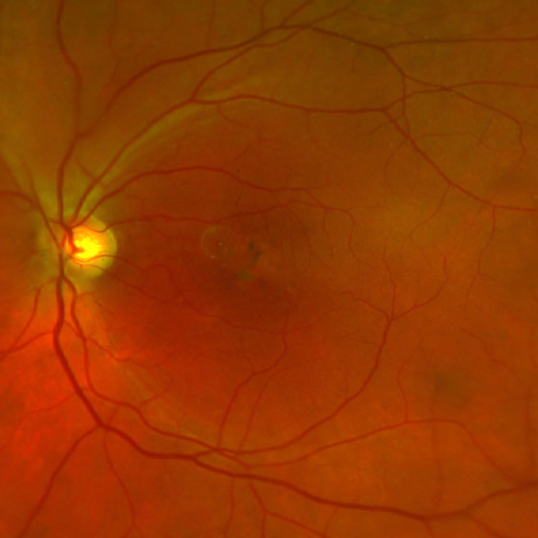 age related macular degeneration