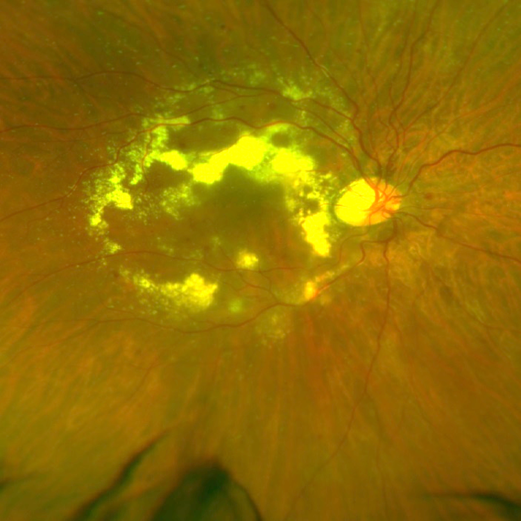 diabetic retinopathy