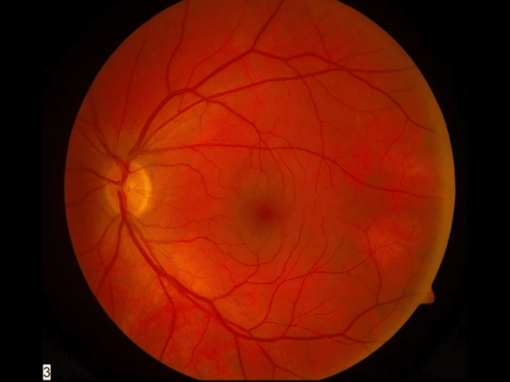 normal retina