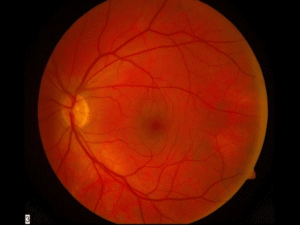 normal retina