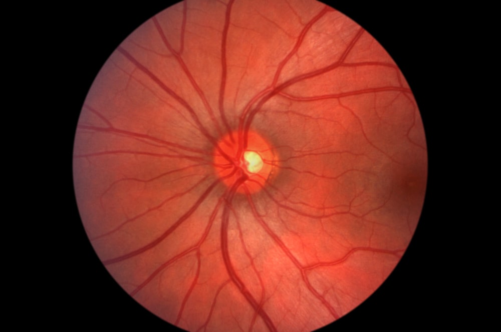 inflammatory and rare retinal diseases California